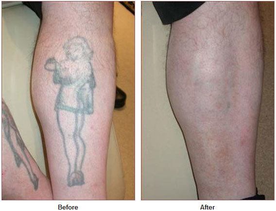 Tattoo Removal - Laser Skin Care Santa Rosa | Artemedica