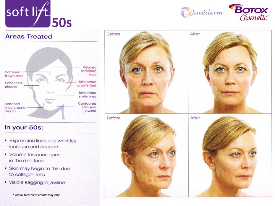 soft lift Results Botox and Juvederm in your 50s