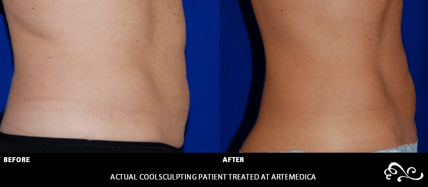 Coolsculpting before and after