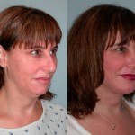 Facelift and Neck Lift before and after