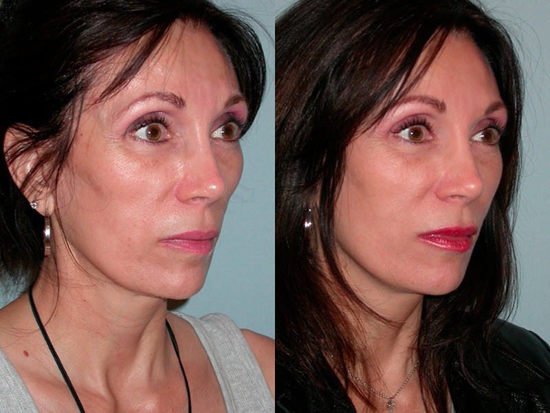 Sculptra before and after
