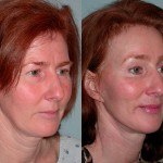 Facelift and Neck Lift before and after