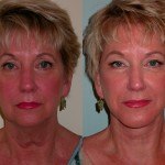 Facelift and Neck Lift before and after