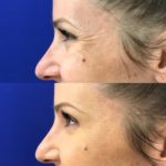 side profile of woman's eyes before and after Botox showing reduced wrinkles