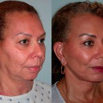 Facelift and Neck Lift before and after