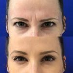 woman's forehead and brow before and after Botox showing reduced wrinkles and smooth skin