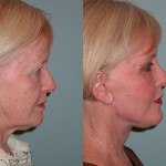 Facelift and Neck Lift before and after