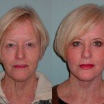 Facelift and Neck Lift before and after Sonoma County