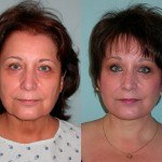 Facelift and Neck Lift before and after