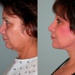 Facelift and Neck Lift before and after