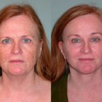 Laser Resurfacing before and after Santa Rosa