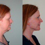 Laser Resurfacing before and after