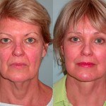 Facelift and Neck Lift before and after woman