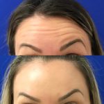 woman's forehead before and after Botox showing reduced wrinkles