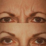 botox before and after above eyes