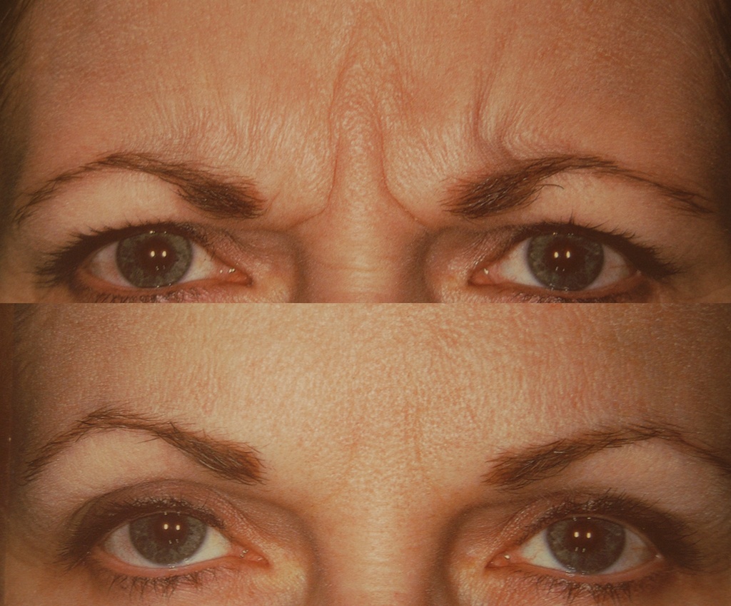 botox before and after above eyes
