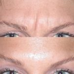botox before and after eyebrows