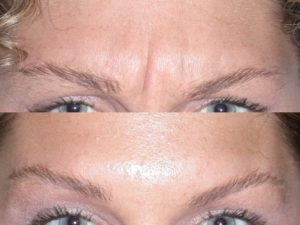 botox before and after eyebrows