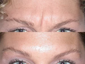 botox before and after eyebrows