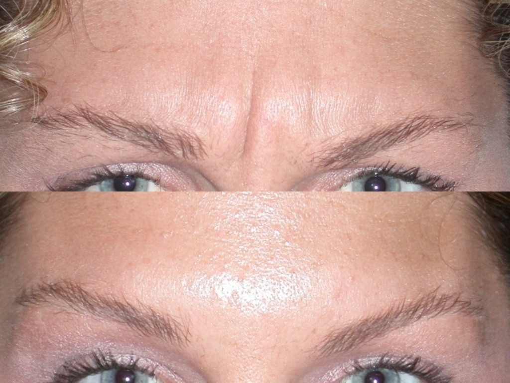 botox before and after eyebrows