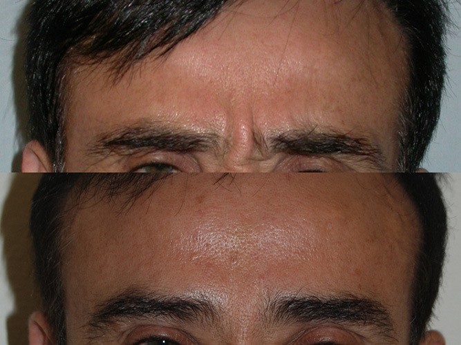 botox before and after eyebrows