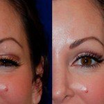 botox before and after above eye