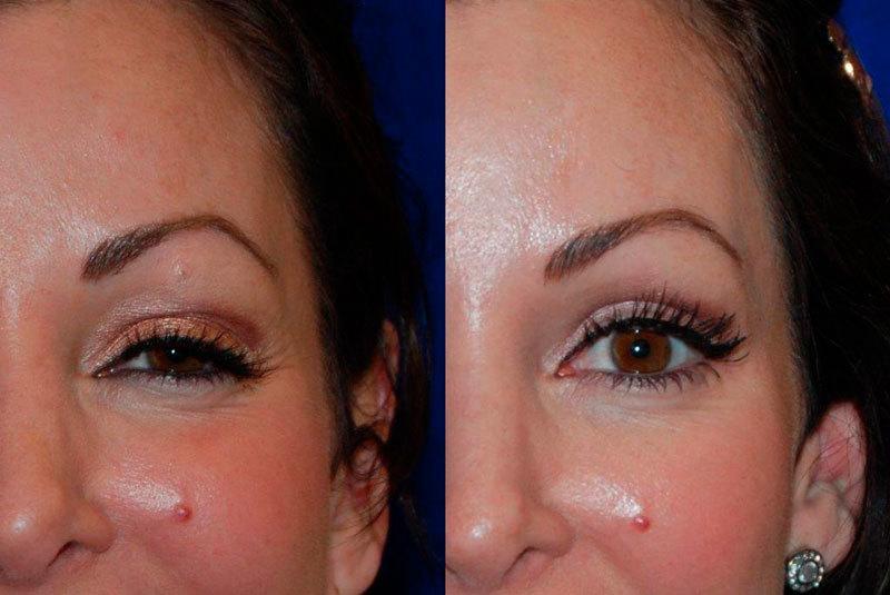 botox before and after above eye