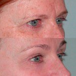 Brow Lift before and after on woman