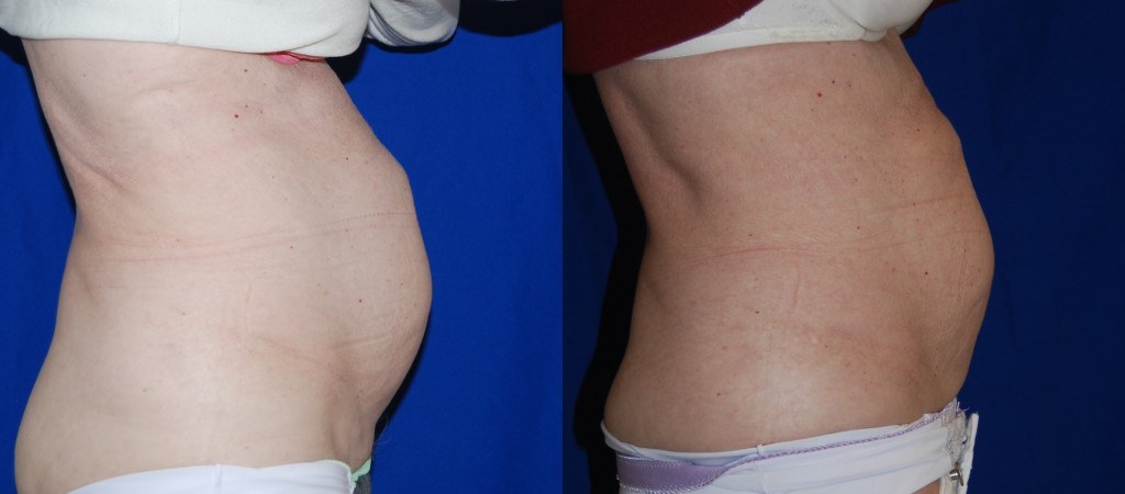 side profile of woman's abdomen before and after Coolsculpting