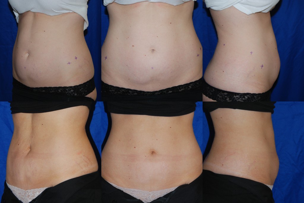 woman's abdomen before and after Coolsculpting