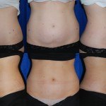 woman's abdomen before and after Coolsculpting