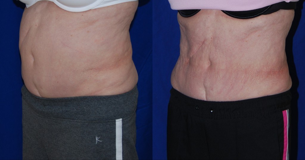 woman's abdomen before and after Coolsculpting