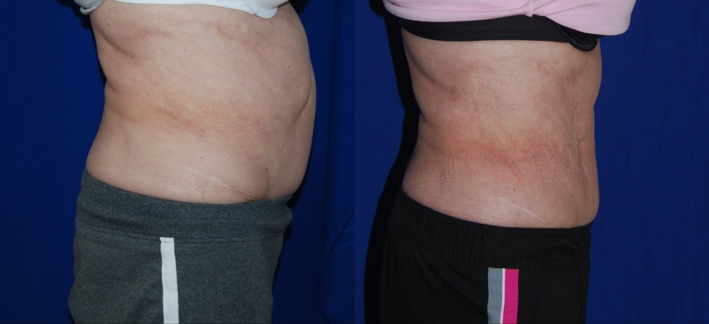 side profile of woman's abdomen before and after Coolsculpting