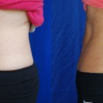 side profile of woman's abdomen before and after Coolsculpting