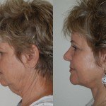 Facelift and Neck Lift before and after