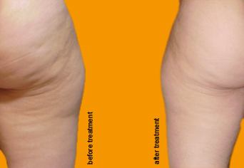 Cellulite Treatment before and after