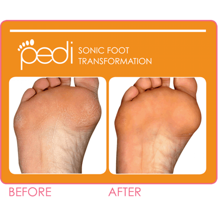 Clarisonic Pedi sonic foot transformation series before and after