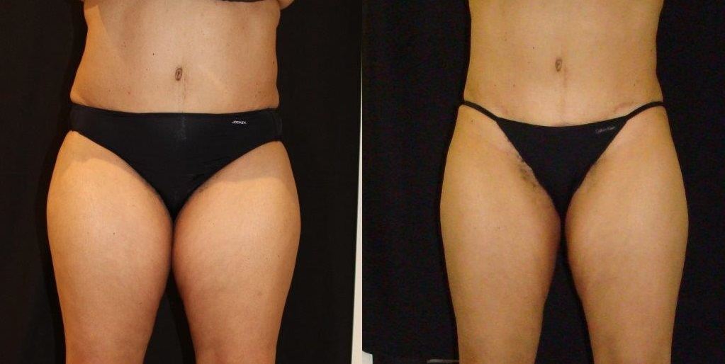 coolsculpting before and after