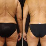 Before and after woman's CoolSculpting treatment to reduce fat and encourage muscle growth