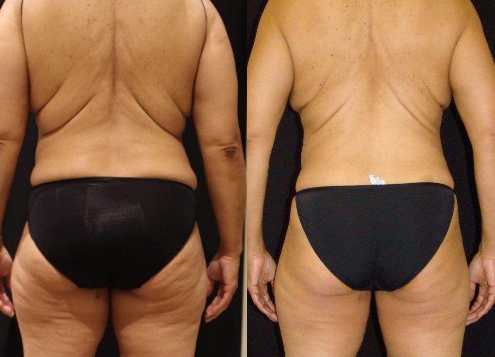 coolsculpting before and after