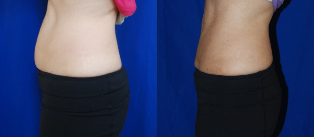 side profile of woman's abdomen before and after Coolsculpting