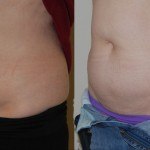 woman's abdomen before and after Coolsculpting