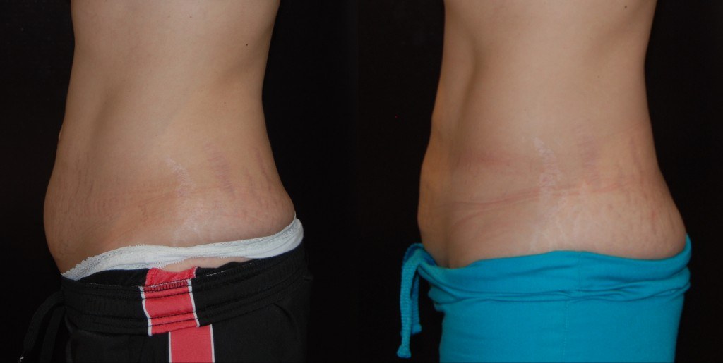 woman's abdomen before and after Coolsculpting