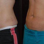 woman's abdomen before and after Coolsculpting