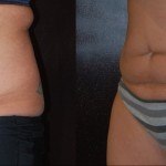 woman's abdomen before and after Coolsculpting