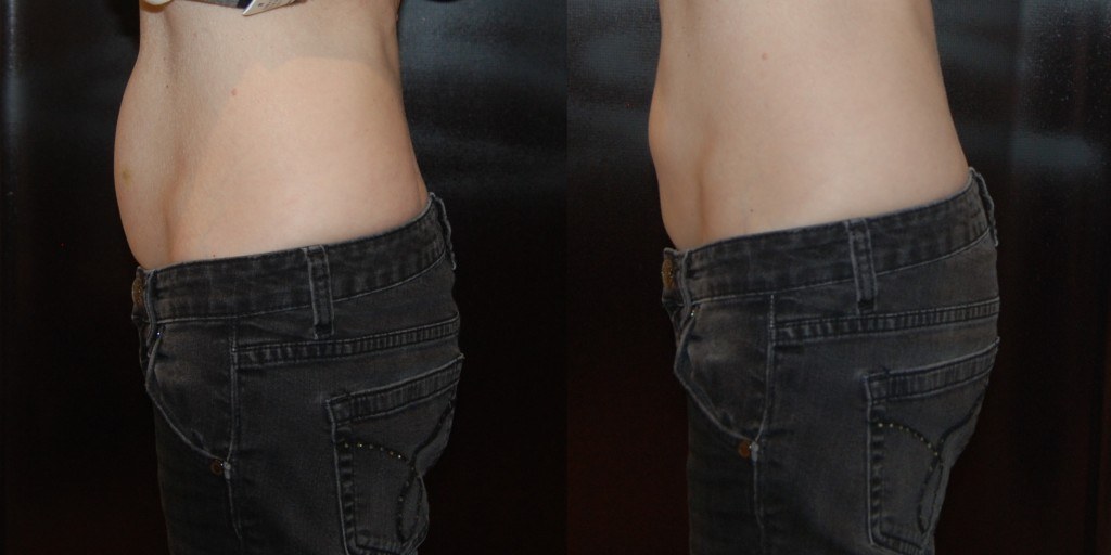 side profile of abdomen before and after Coolsculpting