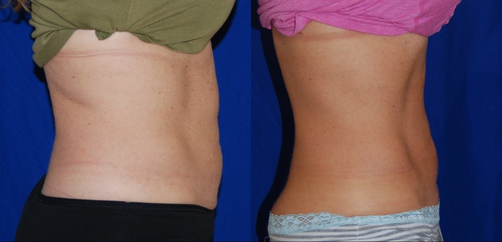 Coolsculpting, Before and After