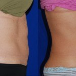 Coolsculpting, Before and After