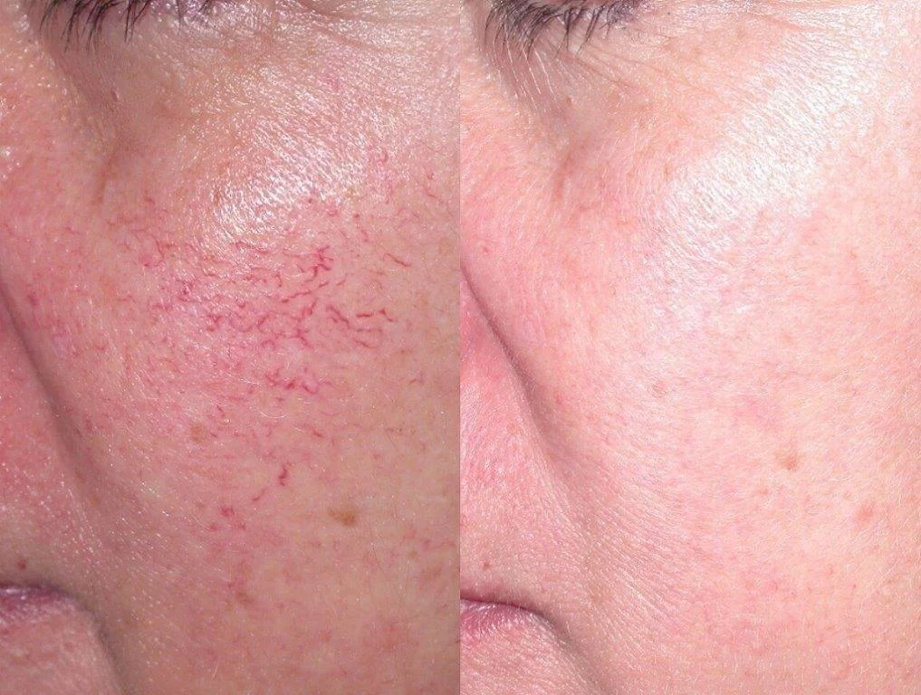 before and after woman's laser spider vein facial treatment