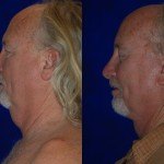 side profile of man's face and neck before and after facelift and neck lift